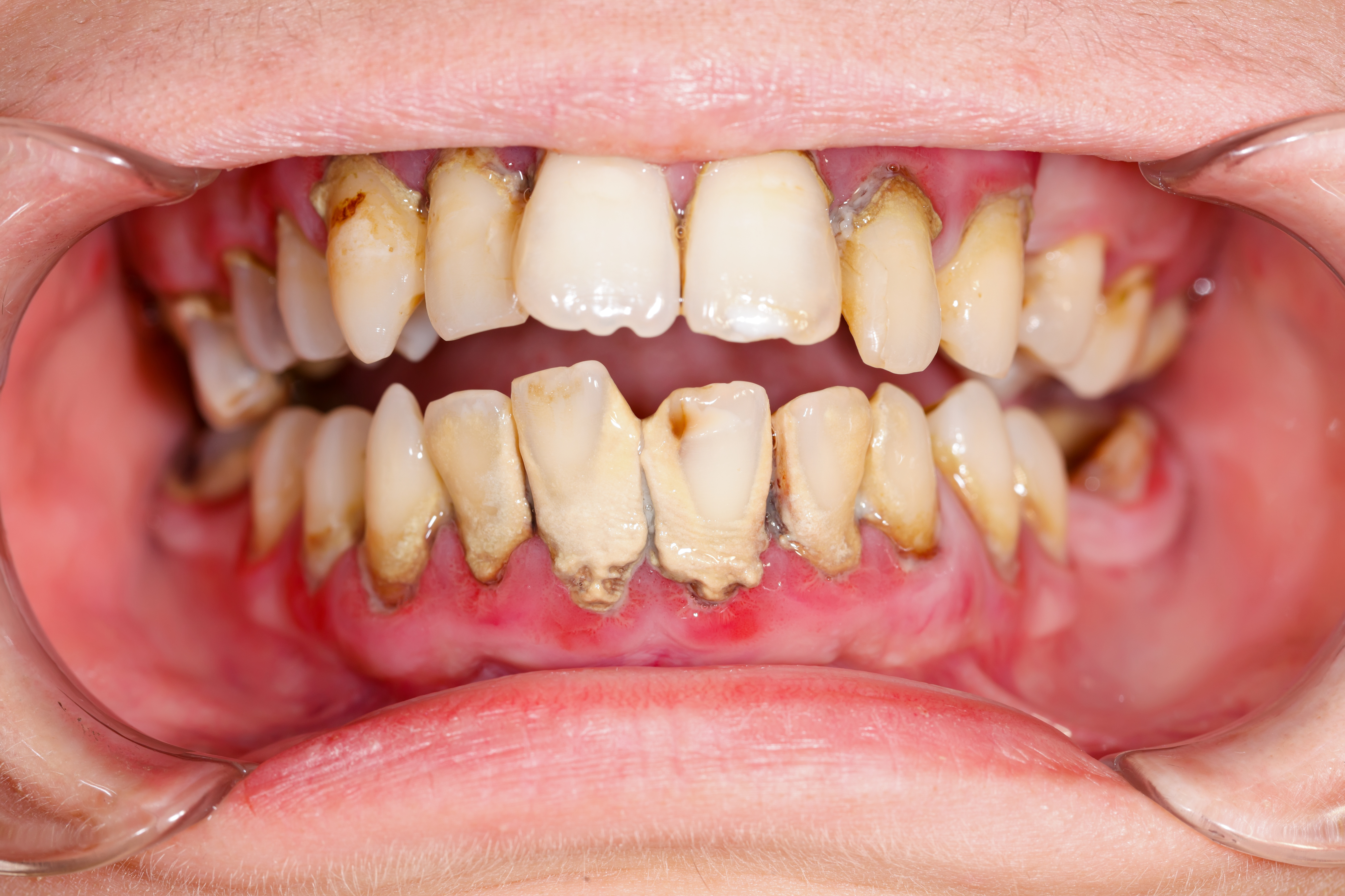 歯ぐきから膿 原因は 応急処置 治療方法について
