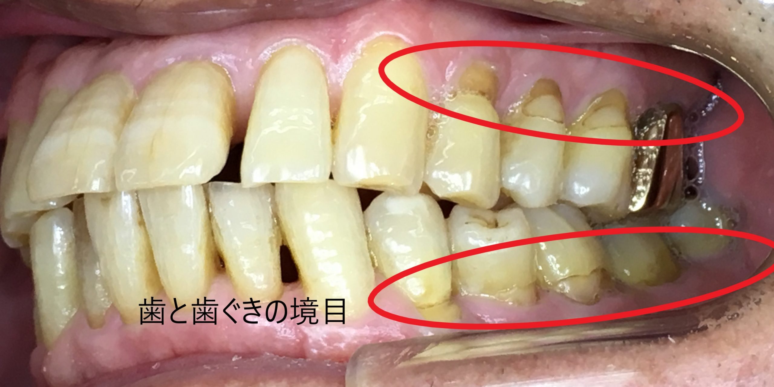虫歯のリスク部位