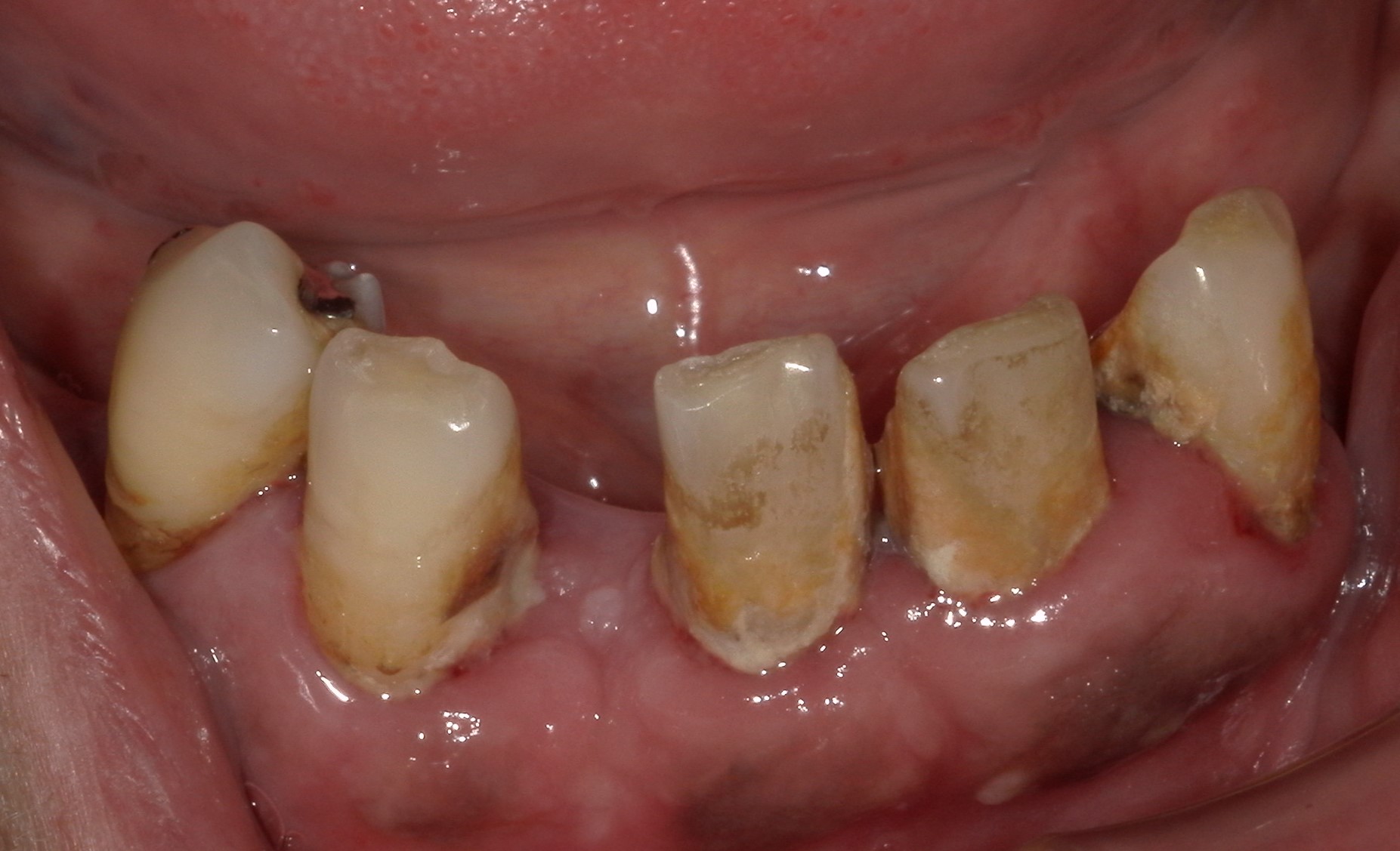 歯ぐきから膿 原因は 応急処置 治療方法について